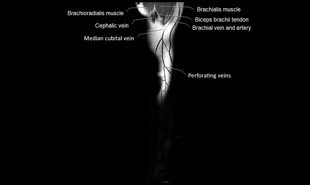 MRI 3T forearm coronal cross sectional anatomy image 2.webp